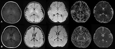 The Value of Diffusion Kurtosis Imaging in Detecting Delayed Brain Development of Premature Infants